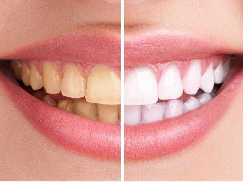 Blanchiment dentaire à Javea - Votre dentiste specialiste à Javea