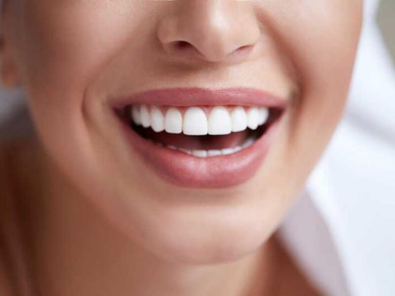 Facette dentaire - Pose de facettes chez votre dentiste à Javea